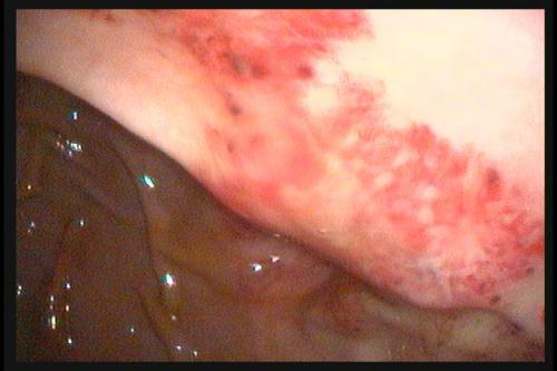 More ulcers